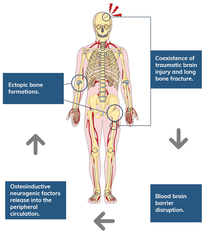 Esquema de la osificación heterotópica neurogénica