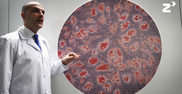 Nuevo tratamiento para la osificación heterotópica neurogénica